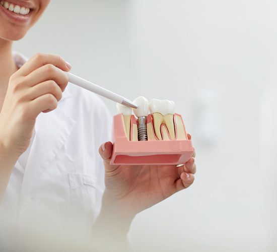 Dental Implants