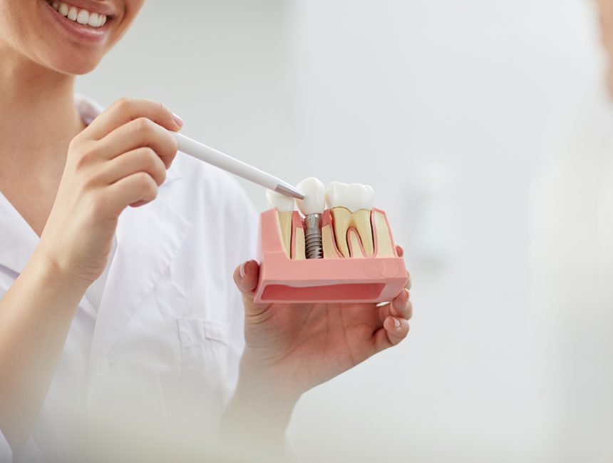 Dental Implants